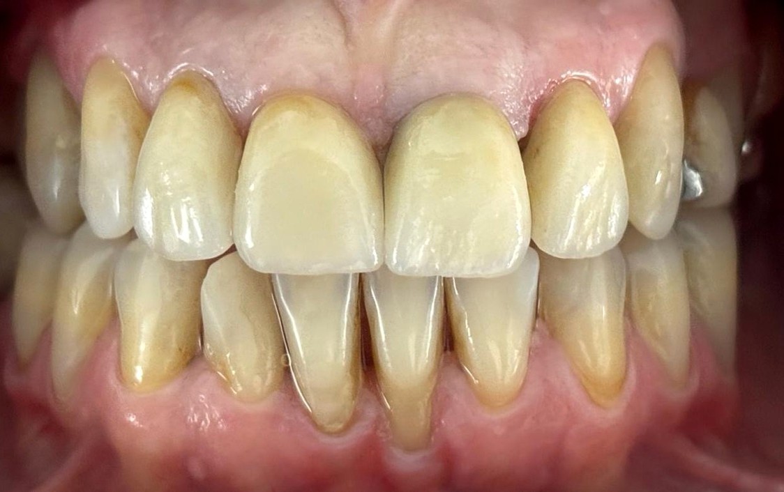 Después del tratamiento estético dental