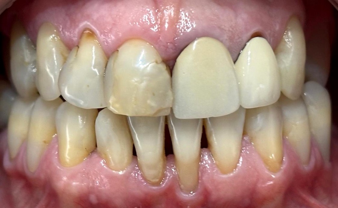 Antes del tratamiento estético dental