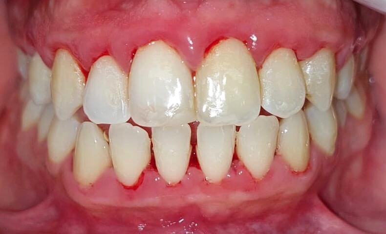 Después de limpieza dental profunda