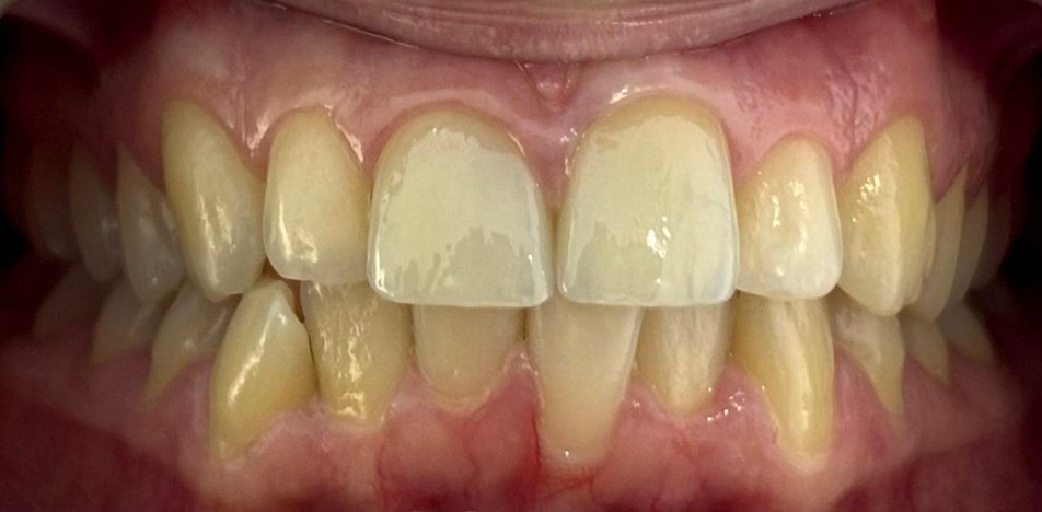 Después del tratamiento dental